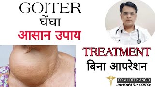 Best treatment of goiter without surgery । Cause of goiter । गलगंड का होमियोपैथी इलाज़ । [upl. by Wivina]