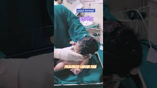 caput formation during vaginal deliverynewborn birthshortsvideo [upl. by Yuma]