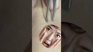 Pluck out that pesky ingrown hair right away fixers satisfying hair hairfix pimple ingrown [upl. by Ahsei]