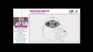 Horizontal canal BPPV understanding the mechanisms [upl. by Fagen]