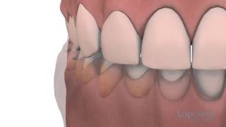 Gingivoplastie et gingivectomie  Centres dentaires Lapointe [upl. by Sherie310]