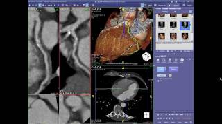 Cardiac CT Angiography Case Review Webinar 101911 [upl. by Yelda]