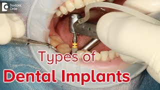 What are the different types of dental implants  Dr Ranjani Rao [upl. by Stelle763]