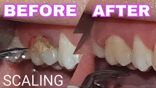 SCALING  Dental Calculus [upl. by Zusman]