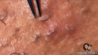 Ingrown Hair Removal Ep24 [upl. by Adoree668]