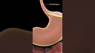 Understanding Achalasia Cardia  Causes amp Solutions [upl. by Akinohs]