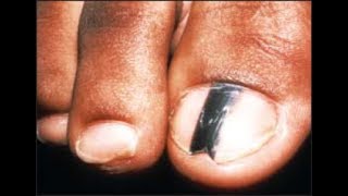 Are Black Toenail Lines amp Streaks Safe Doctor Treatment [upl. by Iosep]