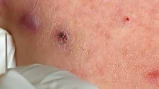 Acne Treatment 2023  Pimples Removal EP126 acne blackhdeads relaxing [upl. by Eugine]