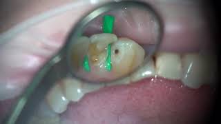 ErYAG laser Fotona LIghtWalker caries cavity preparation [upl. by Mora]