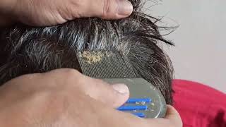 ASMR Scratching Dandruff [upl. by Timothee596]