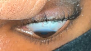 CHANDRA HOA SCLERALS for Keratoconus [upl. by Aiouqes84]