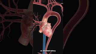 Heart Stent Angioplasty What is heart stent [upl. by Pelagias]