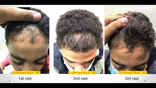 Frontal hair line disorders part 2 [upl. by Yate]