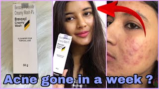 Brevoxyl Cream FaceWash for Rs 139 Review  Benzoyl Peroxide Creamy Wash Review  Somi Singh [upl. by Rajewski]