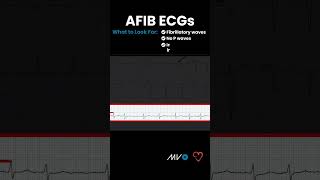 What to Look for in an AFib ECG [upl. by Siuluj]