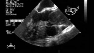 echocardiogramTEE dissection of the ascending aortatype A [upl. by Doralia442]