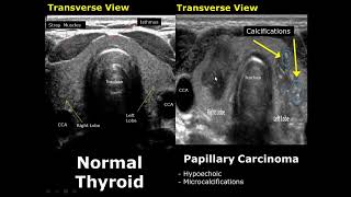 Thyroid Ultrasound Normal Vs Abnormal Image Appearances Comparison  Thyroid Pathologies USG [upl. by Lalage734]