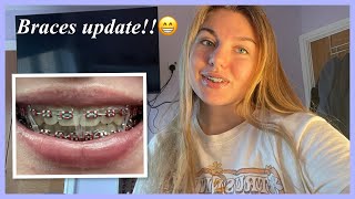 Braces update More elastics🤔⭐️🤍 [upl. by Aillil]