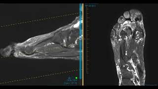 Pain in forefoot and toe from plantar plate tear [upl. by Nabalas780]