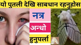 आँखा अन्धो बनाउन सक्ने रोग Symptoms And Causes of Eye disease  Nepali Health Tips [upl. by Ecinwahs]