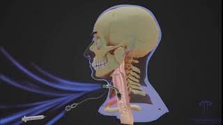 Breathing with a Tracheostomy Tube [upl. by Ernaline606]