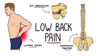 Low Back Pain Explained Including Red Flags [upl. by Nnayllas]