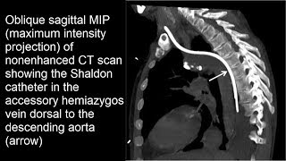 Fehllage Shaldon Katheter akzessorische Vena hemiazygos [upl. by Leif695]