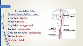 Pseudobulbar Palsy [upl. by Ynahirb]