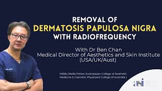 Removal of Dermatosis Papulosa Nigra with Radiofrequency [upl. by Annaeirb]