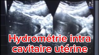 Abdomen ultrasound Hydrométrie intra cavitaire utérine ultrasound [upl. by Evetta]