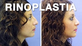 Rinoplastia y Septoplastia antes y después  Cristina [upl. by Nosauq]