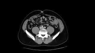 Small Bowel Carcinoid [upl. by Berny953]