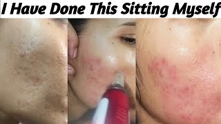 Acne Scars Remove At Home  First Sitting Before amp After  Acne ScarsChiken Pox Scars Remove [upl. by Leamse]