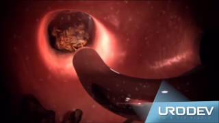 URETERORRENOLITOTRIPSIA FLEXIVEL LASER CALCULOS RENAIS FINAL [upl. by Calbert]