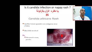 Is it candidal infections or nappy rash irritant dermatitis Ammoniacal dermatitis miconazol zinc [upl. by Sorgalim909]