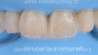 Unica Anterior the one solution to anterior restorations [upl. by Lednor]