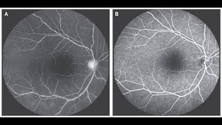 Vaskulitis der Retina bei Takayasu Arteriitis [upl. by Atrebla322]