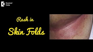 INTERTRIGO  Rash in Skin Folds  Causes Symptoms and Treatment  DrNischal K C  Doctors Circle [upl. by Reyem]