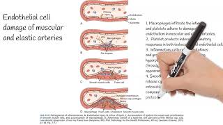 Atherosclerosis  Causes Pathogenesis Prevention [upl. by Anegal]