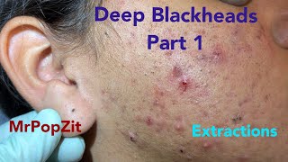 Deep waxy pore plugs removed 20 minutes of extractions with MrPopZit [upl. by Aneleve]