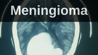 What is a Meningioma Pathology mini tutorial [upl. by Leong]