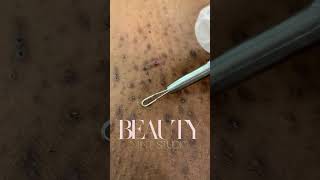 Ingrown Hair Removal Part 1 [upl. by Brenner]