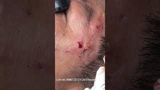 Acne cystic acne inflammatory acnecystic acne hidden acneTechnique for removing acne with a cotton [upl. by Nwahsat]