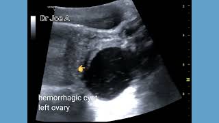 hemorrhagic cyst ovary Ultrasound and color Doppler video [upl. by Ahsaya]