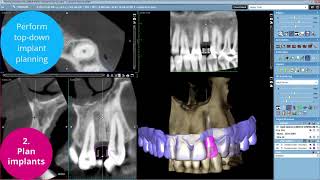 Planmeca Romexis — The Complete Implant Workflow [upl. by Colis63]