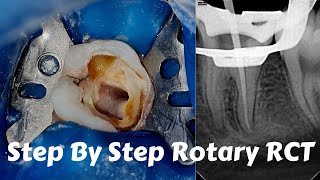 Live Steps Root Canal Rotary Protaper Endodontic Procedure ACP BMP obturation irrigation [upl. by Fritzie311]