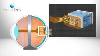 How the Argus II works [upl. by Ellenyl]