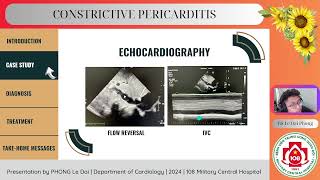 Constrictive pericarditis [upl. by Onateag24]