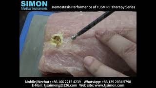 Simon RF ablation preformences [upl. by Malet]