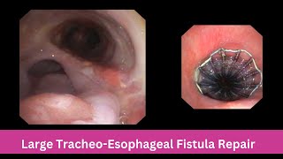 Large Tracheo  Esophageal Fistula  Bronchoscopic Repair [upl. by Kellby]